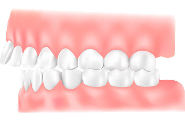 上顎前突 出っ歯 イラスト