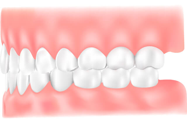 鋏状咬合のイラスト