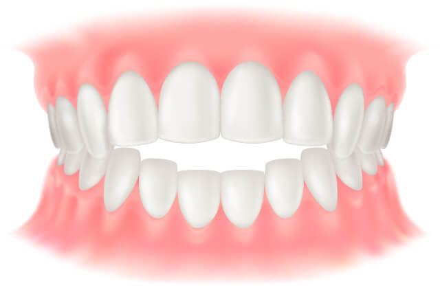 開咬 オープンバイト イラスト