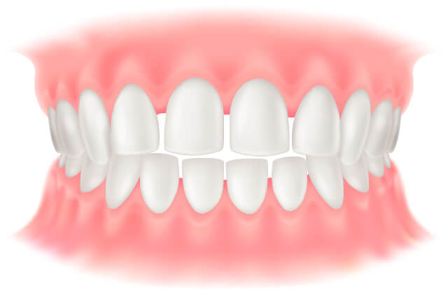 正中離開 すきっ歯 イラスト