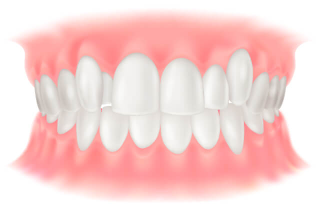 叢生 八重歯・歯並びの凸凹 イラスト
