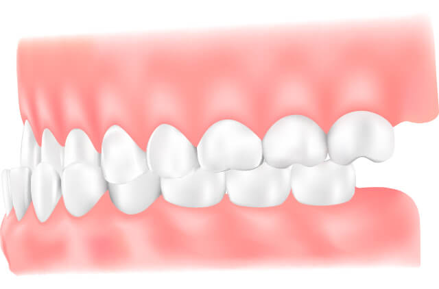 受け口 反対咬合 イラスト
