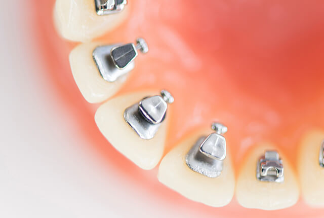 矯正装置を装着した歯の模型