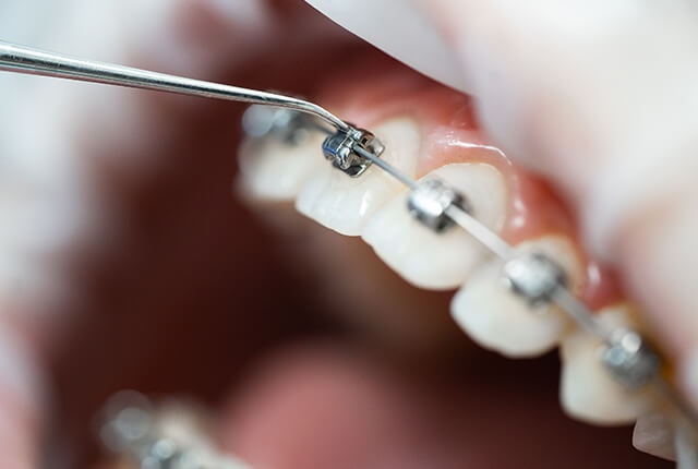 矯正装置を装着した歯の検診