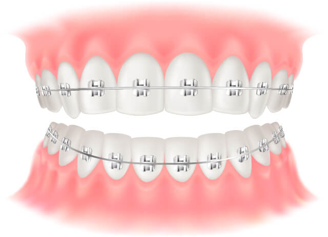 表側矯正 ワイヤー矯正 イラスト