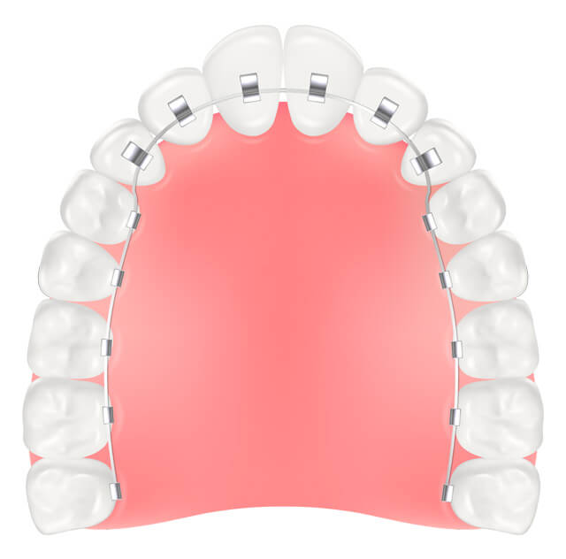 裏側矯正 舌側矯正 イラスト