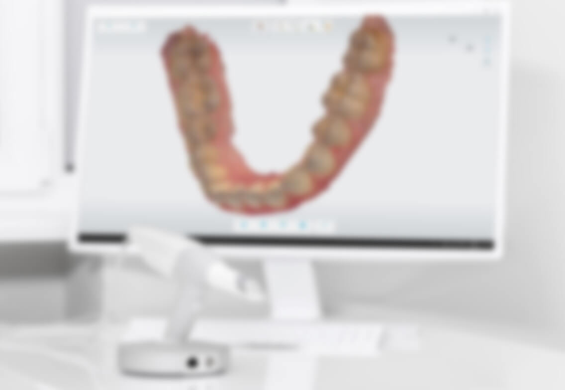 口腔内スキャナーのイメージ