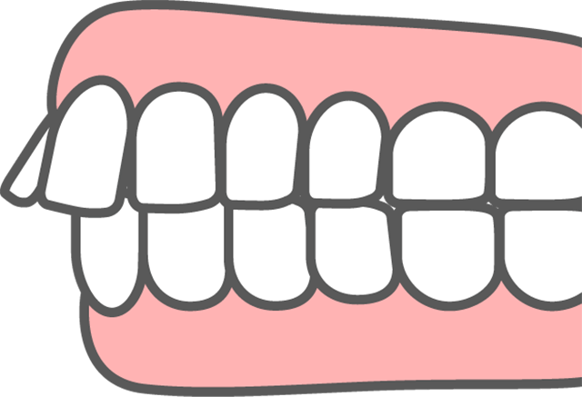 上顎前突 出っ歯 イラスト
