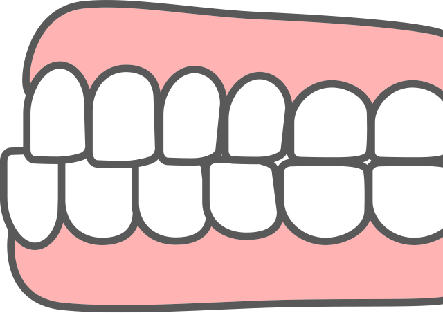 下顎前突 受け口 イラスト