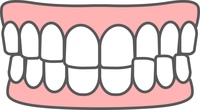 交叉咬合 イラスト